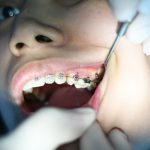 Verbeter je glimlach met de innovatieve technieken van DGTL Dental Lab